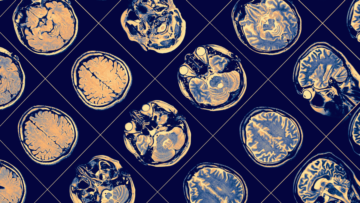 Rows of MRI images of the brain