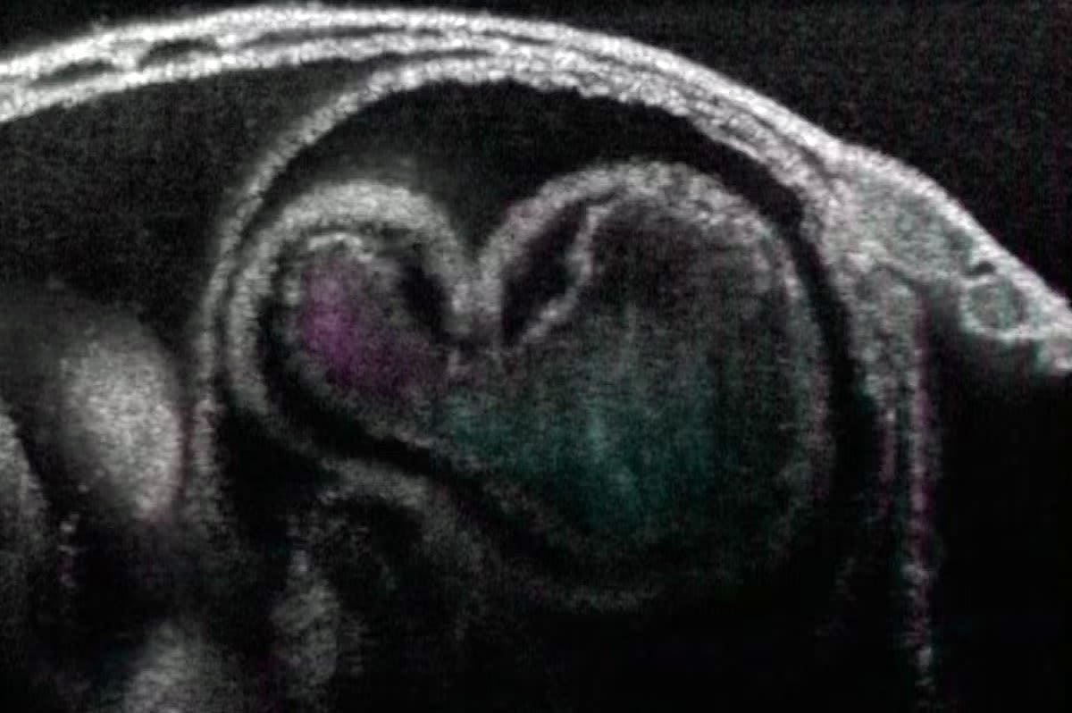 Embryonic heart
