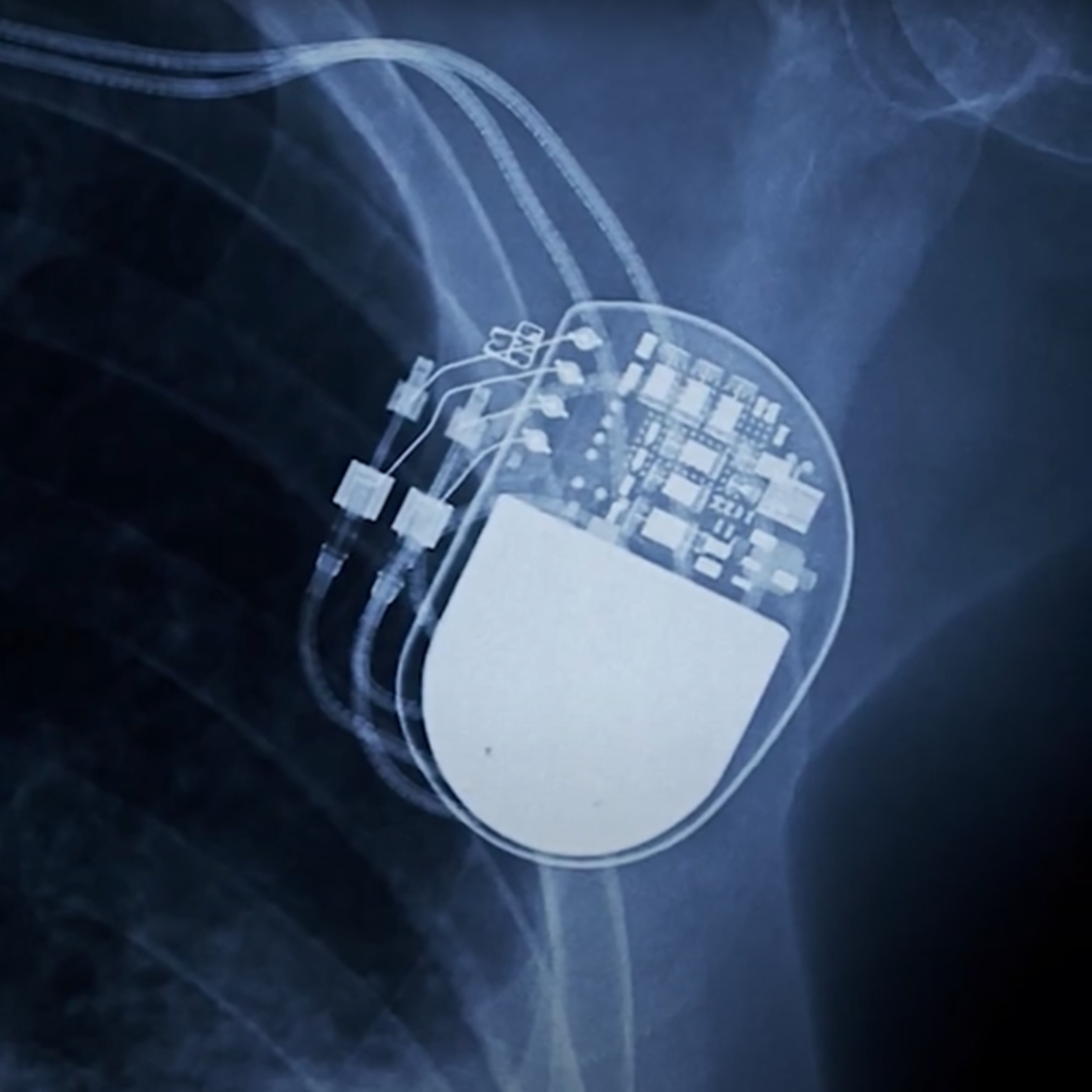 X-ray image of an implanted device in a human body. 