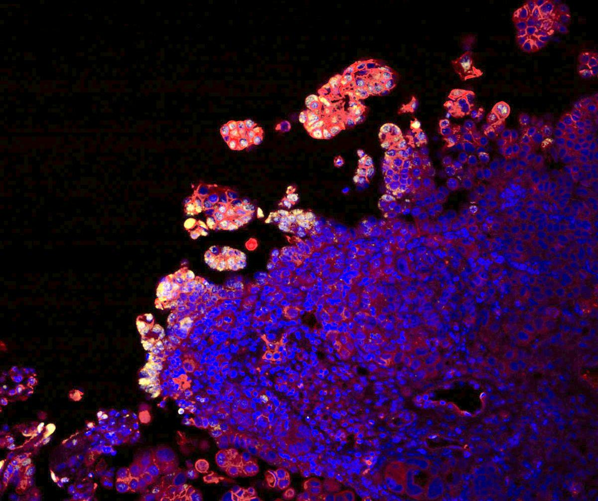Cancer cells shown in color