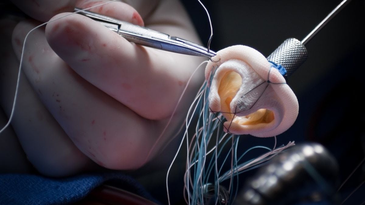 A photo of a medical implant during surgery
