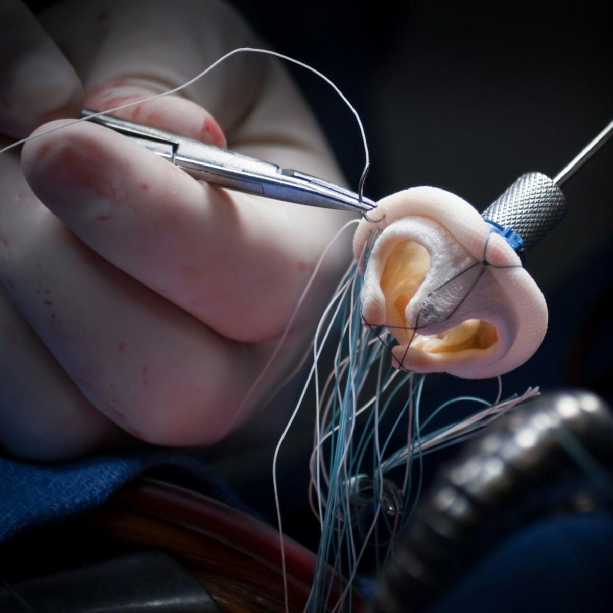 A photo of a medical implant during surgery