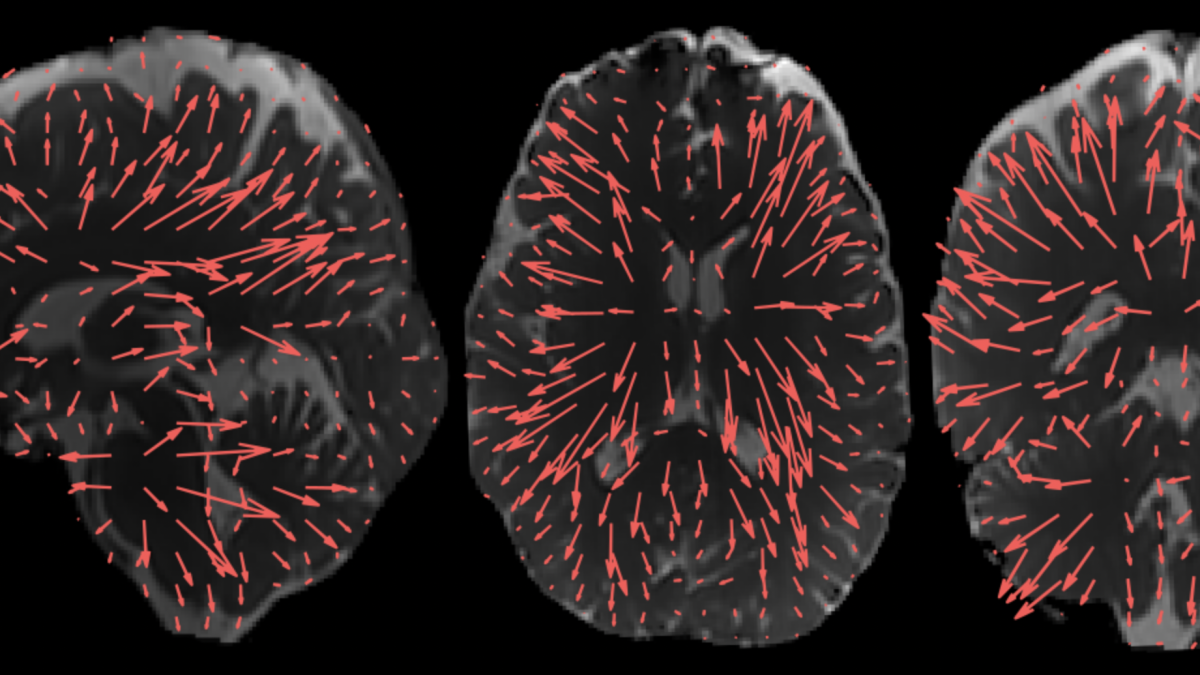 Three slices of the brain with red arrows within them. Each red arrow is a different length and width, corresponding to the direction and amplitude of the brain moving in three dimensions.