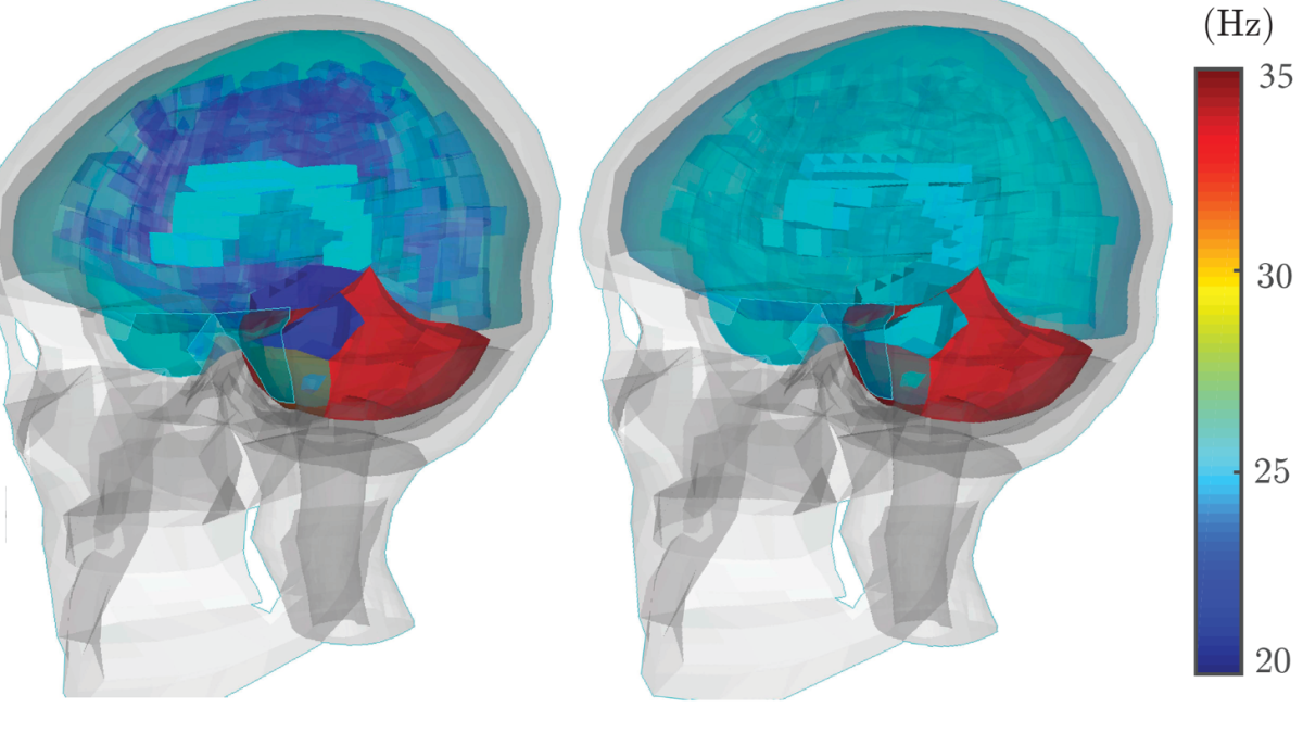 Differences in brain dynamics in injured vs. non-injured athletes. The left side shows the injury; the right side shows a non-injury. CREDIT: KurtLab