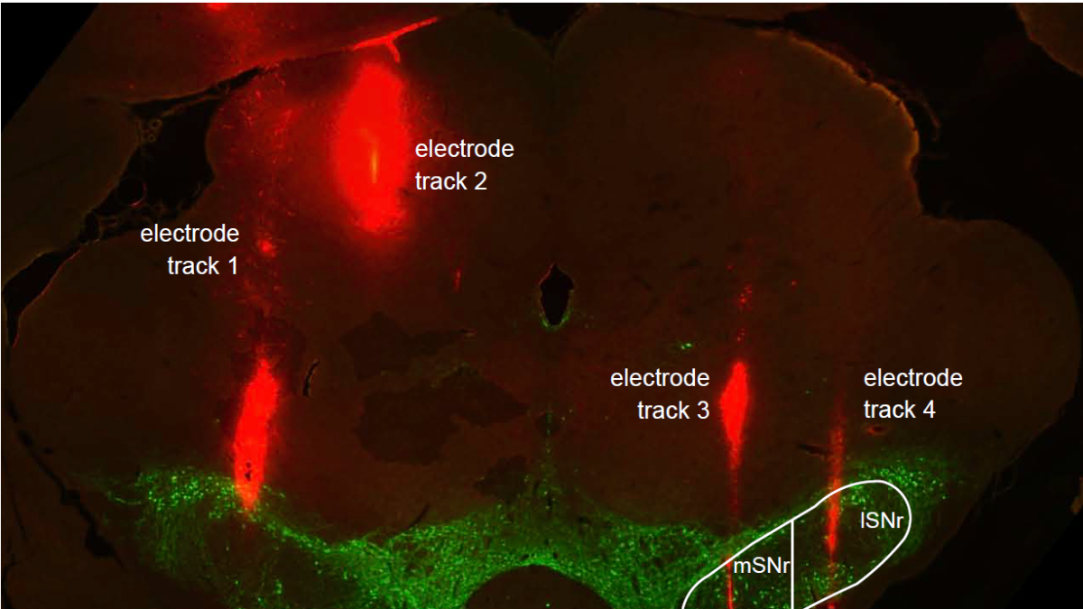 A technique called immunohistochemistry is used to visualize protein expression in the brain following deep brain stimulation. Green indicates dopamine-containing nerve cells and red indicates deep brain stimulation electrode tracks
