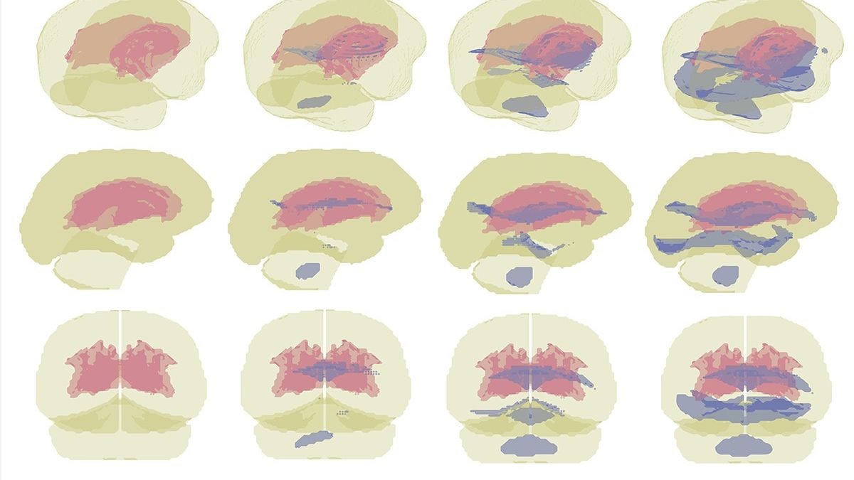 three rows of 4 brain images, sagital, coronal and 3D