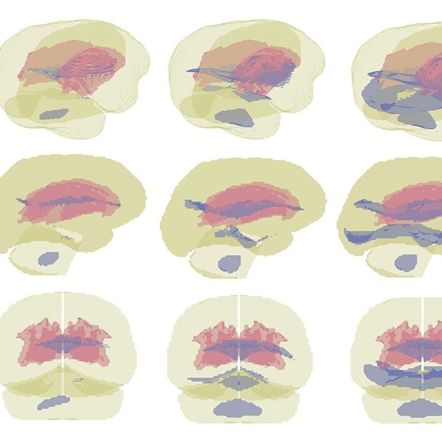 three rows of 4 brain images, sagital, coronal and 3D